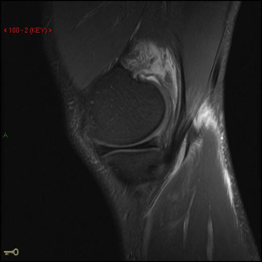 Figure 3 for case Medial head of gastrocnemius muscle ( RID2921 ) avulsion